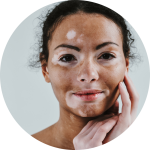 vitiligo