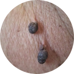 warts & skin tag removal